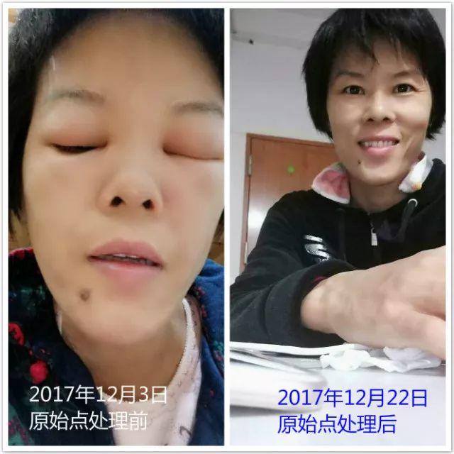 原始点调理附子中毒：细节决定成败