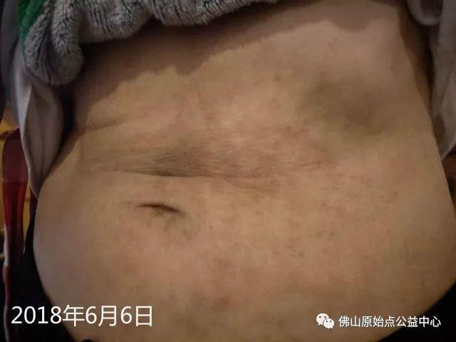 原始点调理带状疱疹：轻松快捷效果好