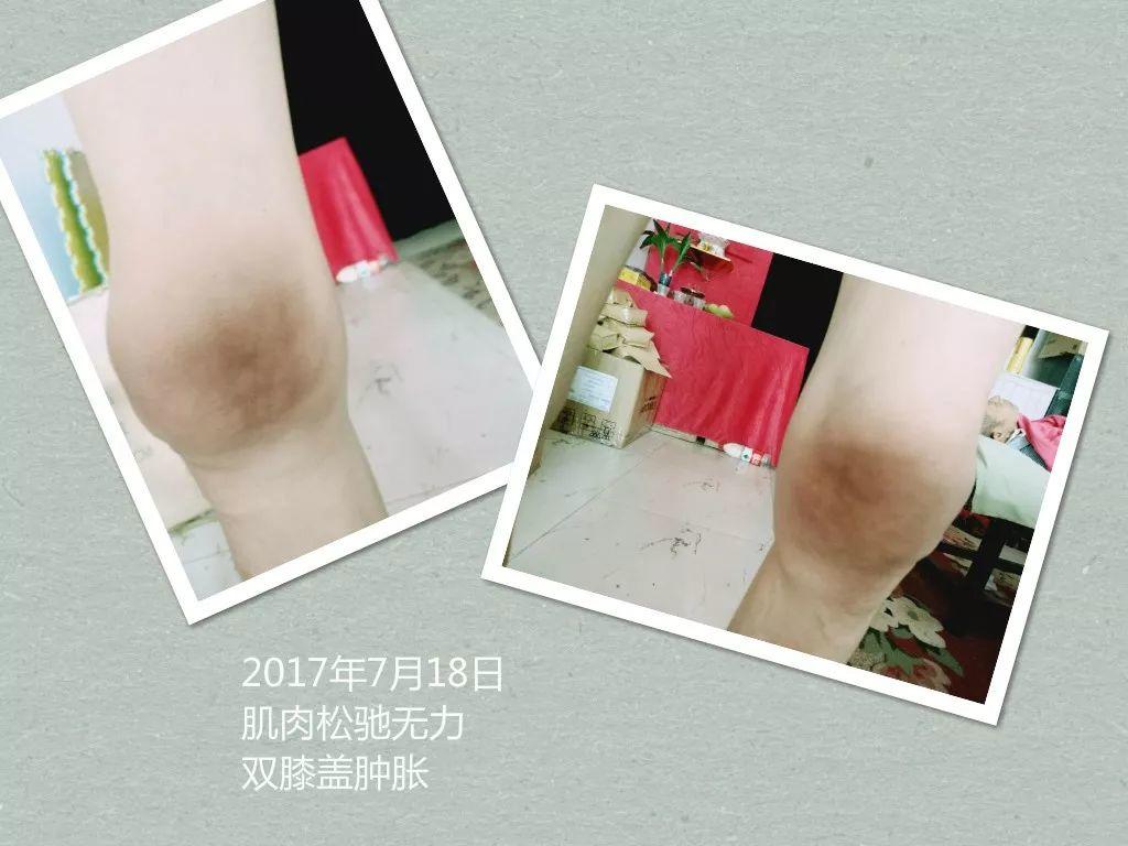 原始点调理手脚肿胀、极度疼痛：《好转来得如此快》