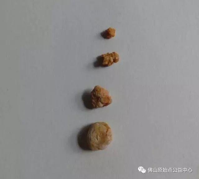 本中心学员花开深圳，原始点调理，先后自然排出肾结石