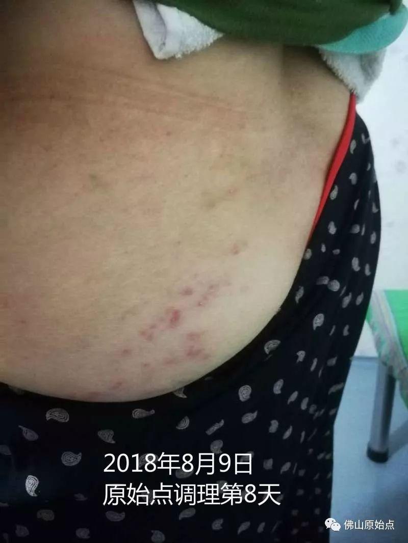 原始点调理带状疱疹：又快又彻底