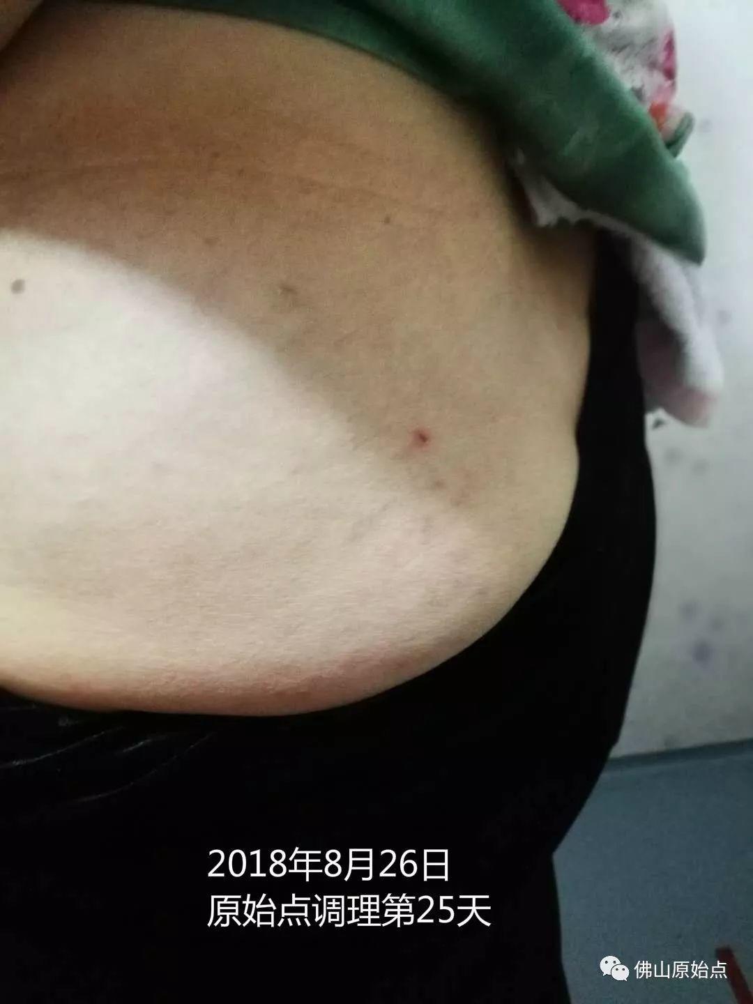 原始点调理带状疱疹：又快又彻底