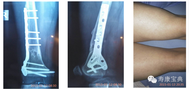 案例分享：原始点调理骨折手术后的恢复
