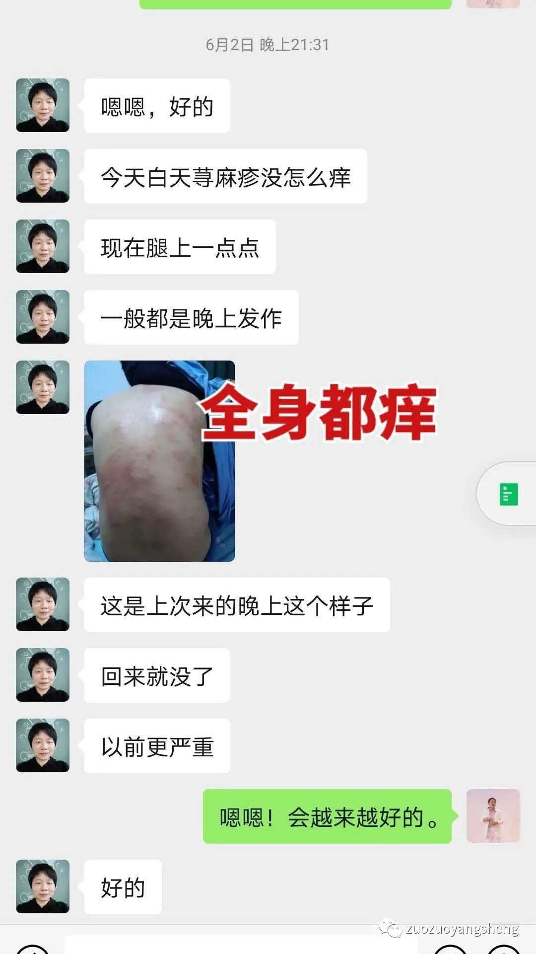 案例分享：原始点调理荨麻疹的好转反应。