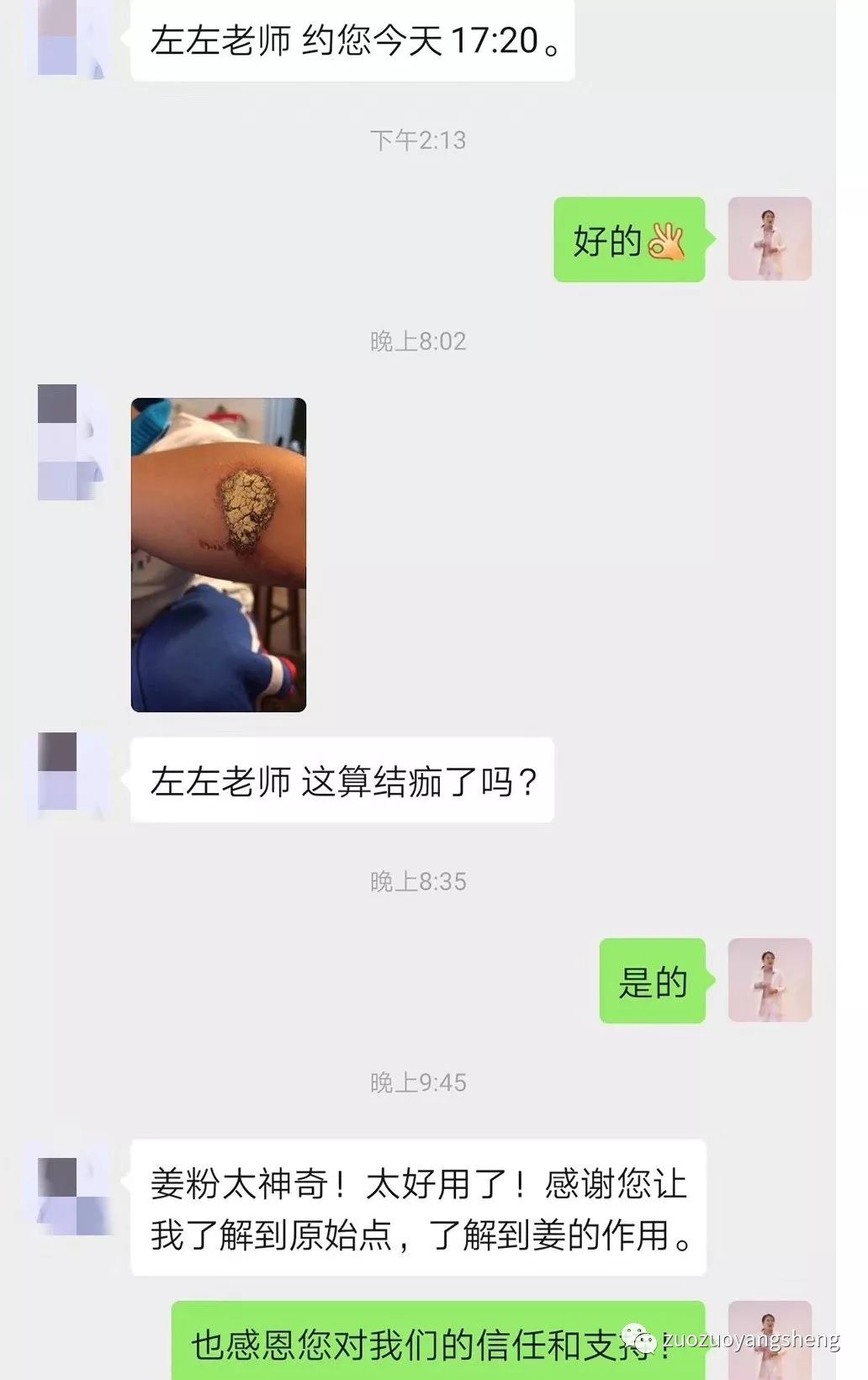 案例分享：原始点调理四岁小孩角膜炎案例