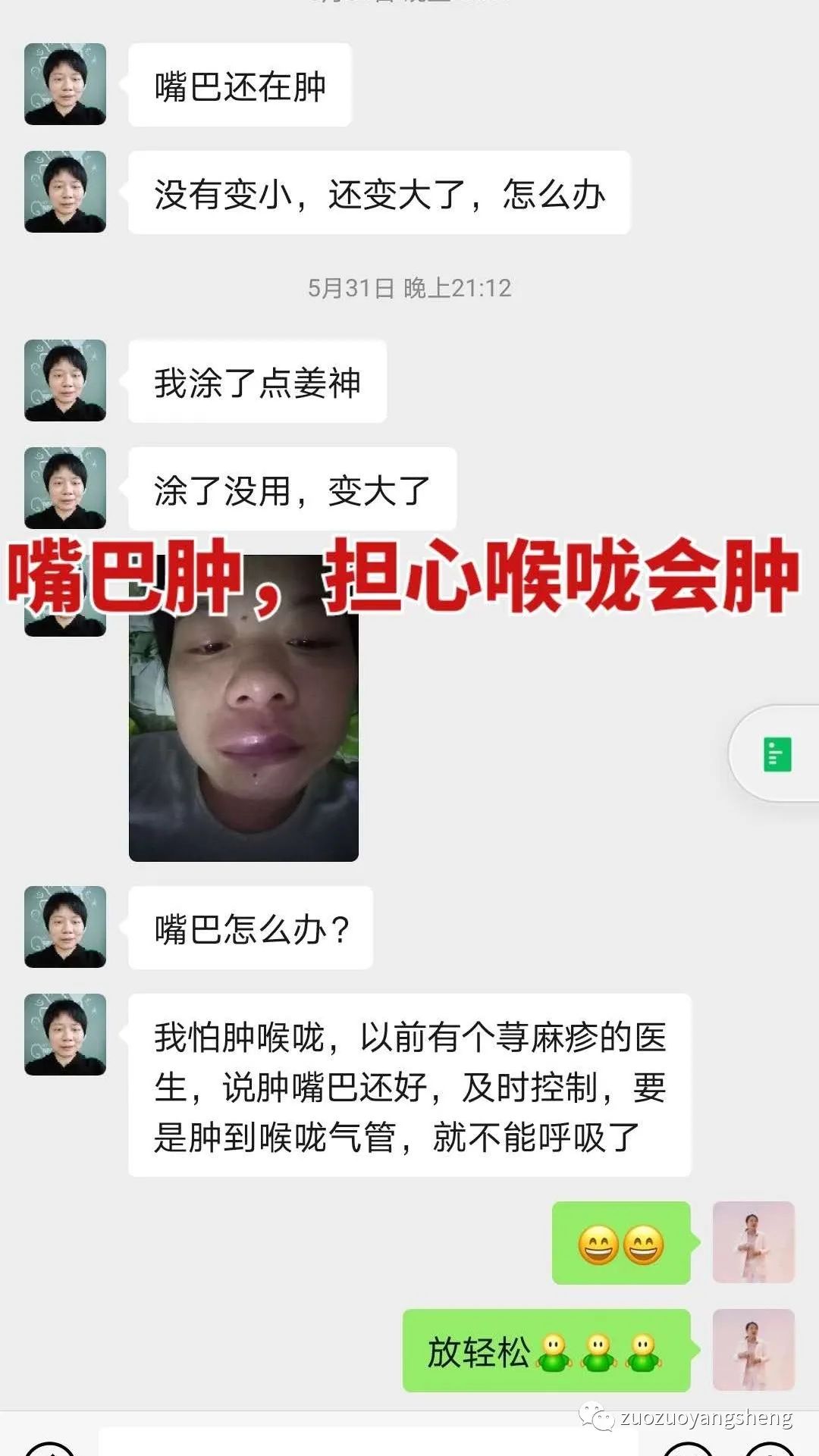 案例分享：原始点调理荨麻疹的好转反应。