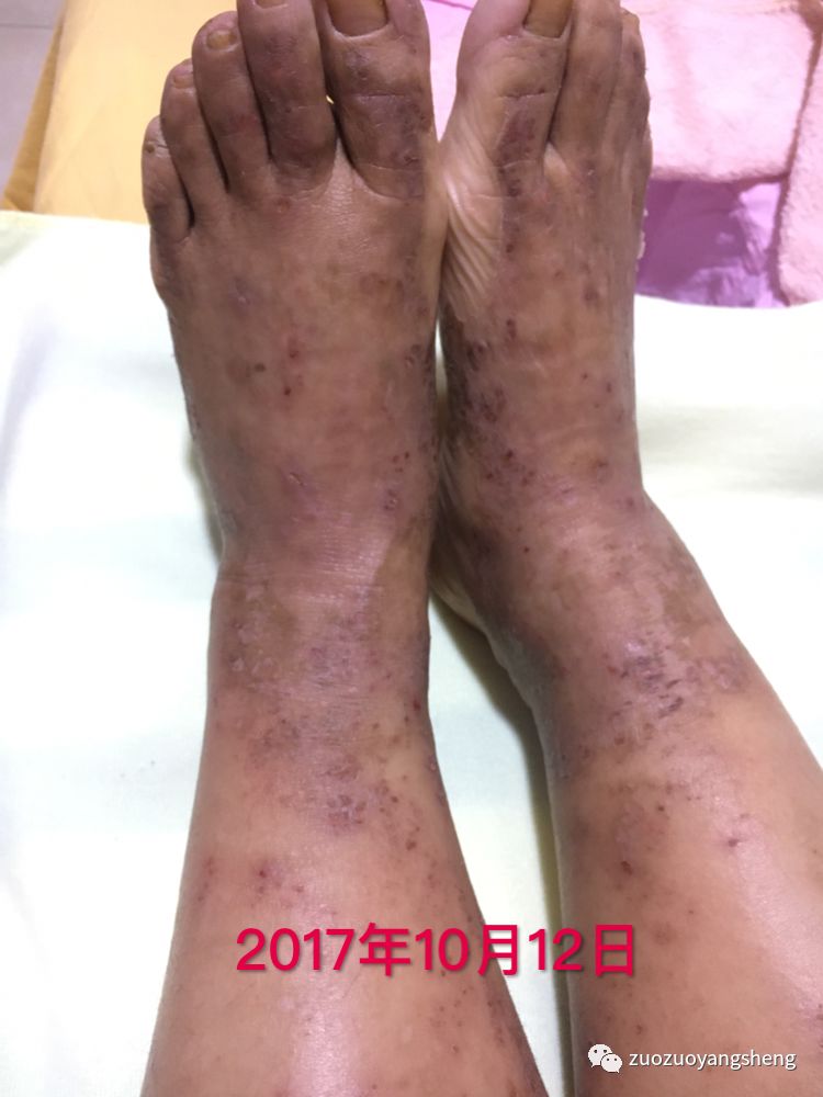 案例分享：原始点调理全身奇痒无比的湿疹案例