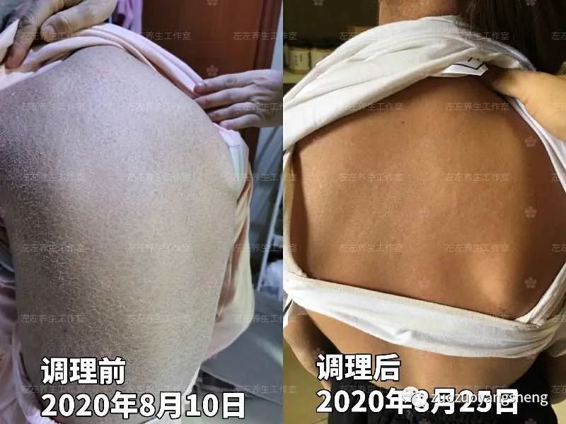 案例分享：馨心公益联合原始点公益帮助大山深处女孩调理全身干癣的案例