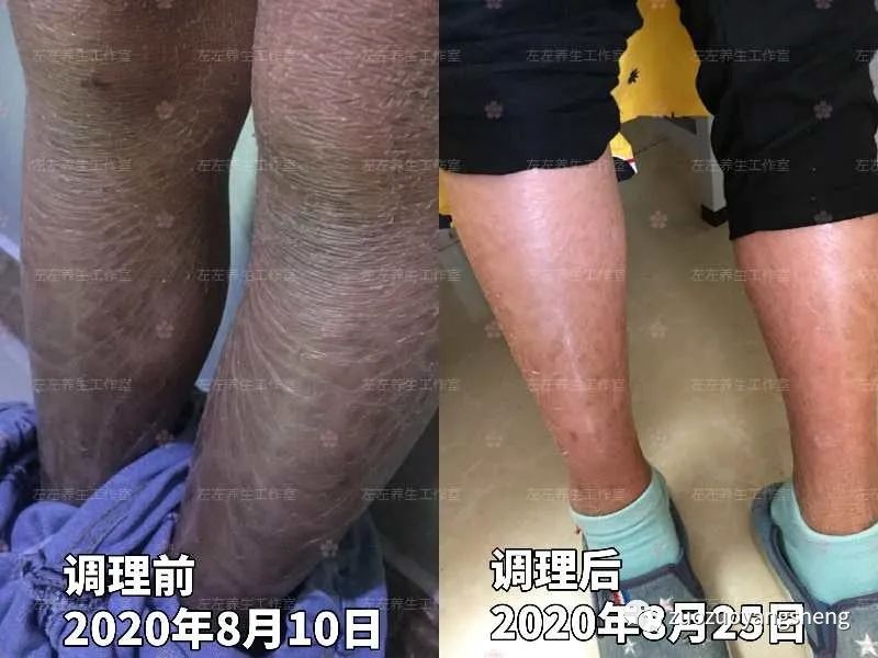 案例分享：馨心公益联合原始点公益帮助大山深处女孩调理全身干癣的案例