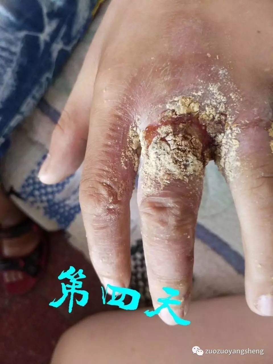 案例分享：原始点调理小朋友手部烫伤的案例