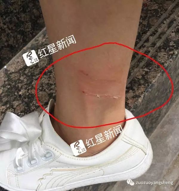 女子被狗咬28天后死 丈夫：为何打了狂犬疫苗也没用？如果学了原始点……