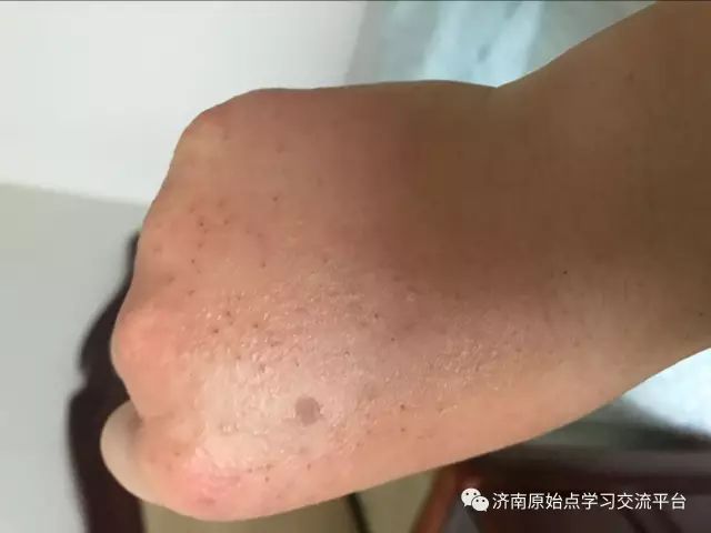 案例分享：巨痒湿疹案例