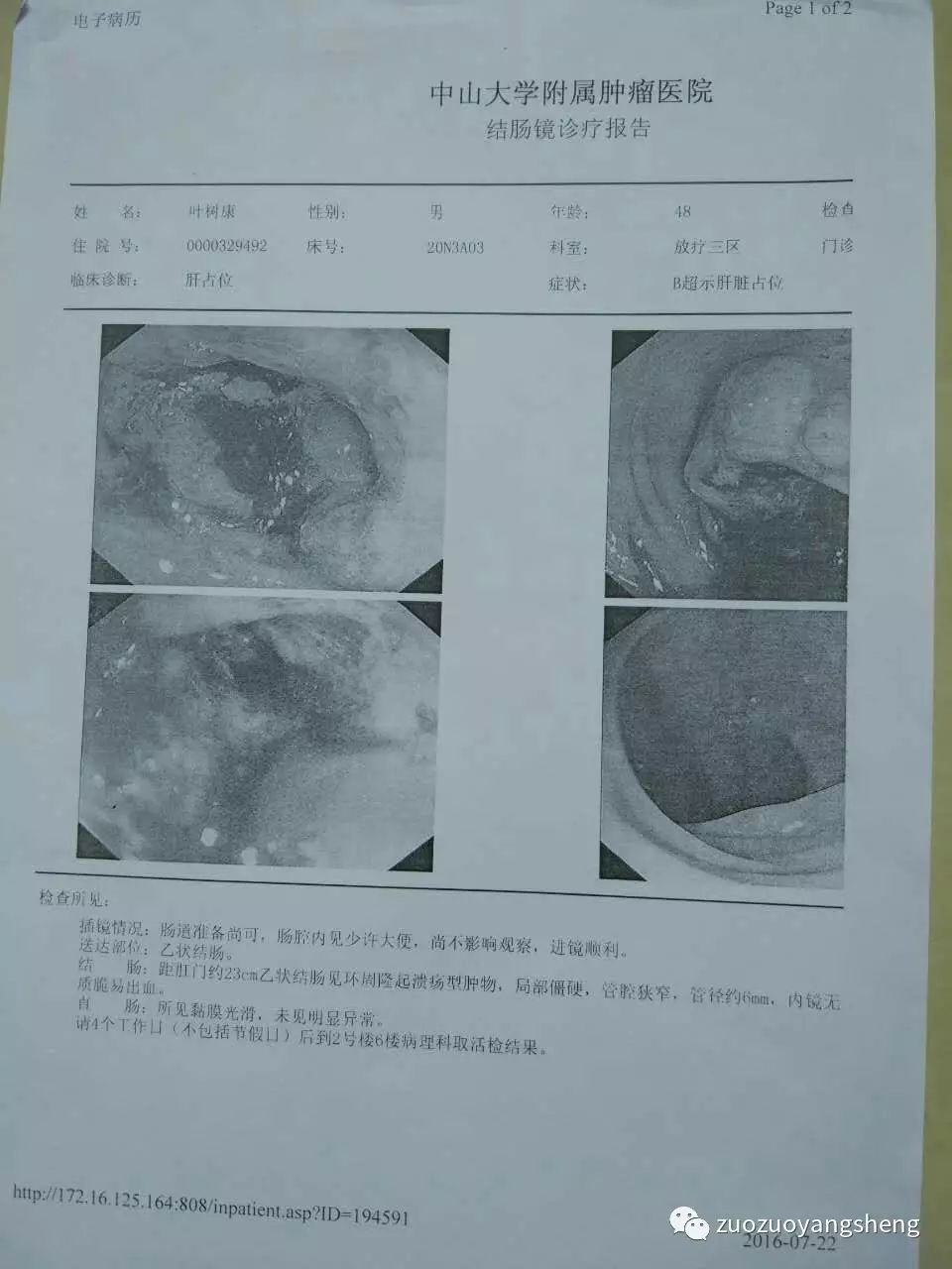 案例分享：原始点调理结肠癌的肝转移、肺转移案例