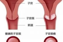 【原始点案例】宫颈糜烂调理-原始点全球同学网