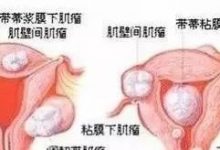 中医解读子宫肌瘤、卵巢囊肿是怎么回事？-原始点全球同学网