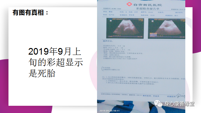 怀胎七月，胎死腹中2月患者康复案例