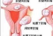 子宫肌瘤、乳腺癌原来是这么回事！看完我目瞪口呆！-原始点全球同学网