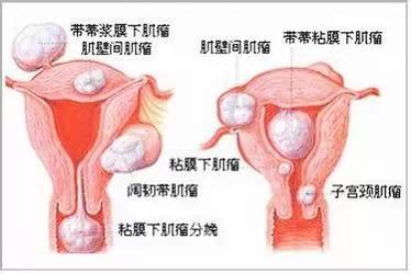 子宫肌瘤、乳腺癌原来是这么回事！看完我目瞪口呆！