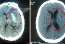 脑出血案例（钟老先生）（简体版）-原始点全球同学网