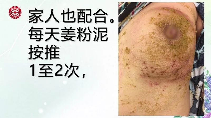 乳腺及淋巴肿块案例