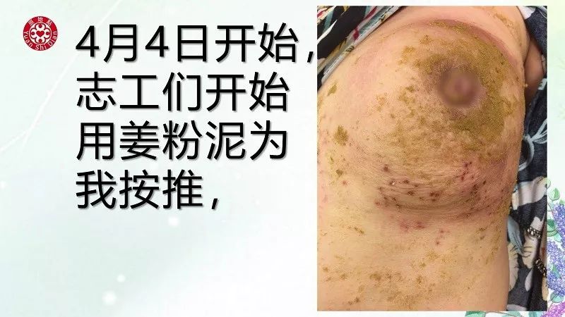 乳腺及淋巴肿块案例