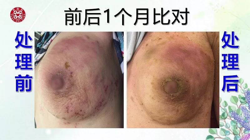 乳腺及淋巴肿块案例