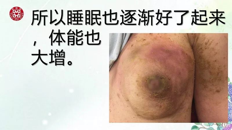 乳腺及淋巴肿块案例