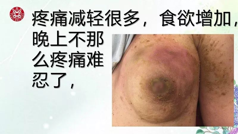 乳腺及淋巴肿块案例