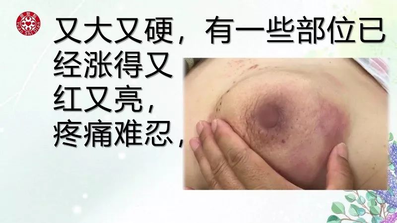 乳腺及淋巴肿块案例