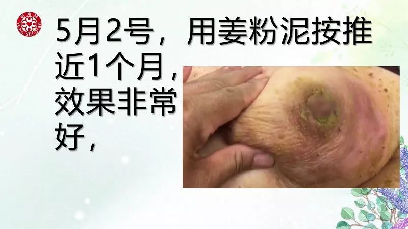 乳腺及淋巴肿块案例