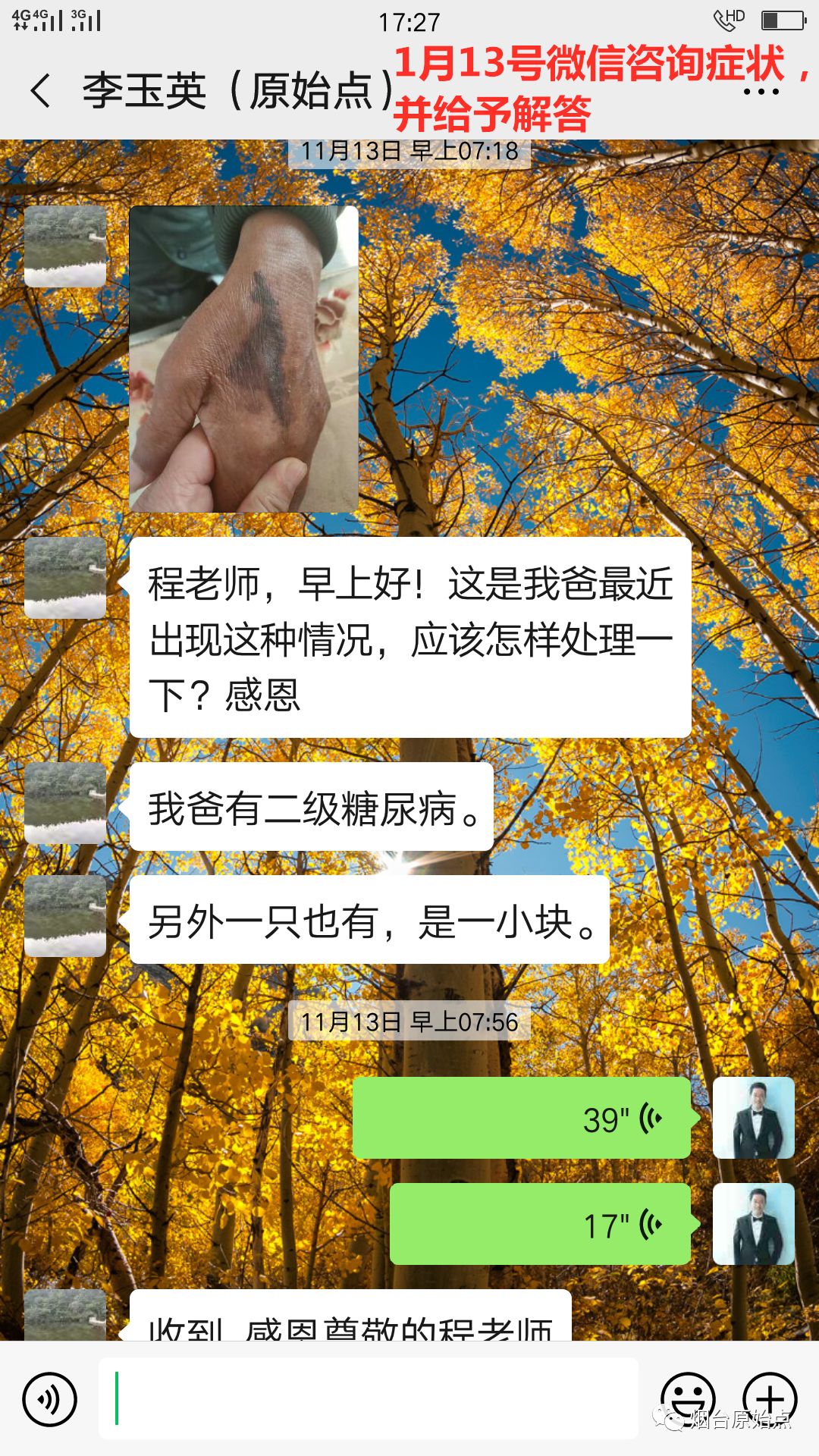 糖尿病手部斑块案例