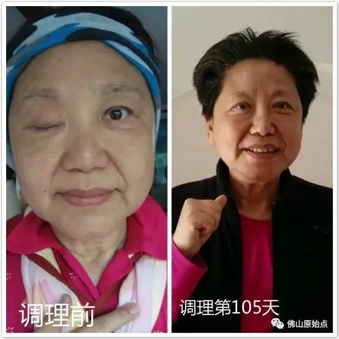 脑血管瘤致右眼无法睁开，原始点调理105天，生活完全恢复正常