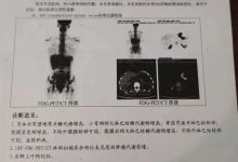 原始点调理胃癌2017-清远人42岁陈淑梅云淡风轻 -一个月后所有症状就改善了70%多，两个多月所有症状都消失了。体力很好，能吃能喝-原始点全球同学网