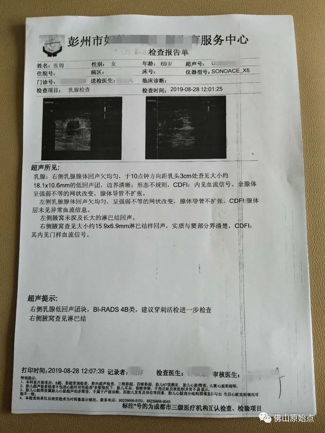 原始点调理浸润性乳腺癌案例