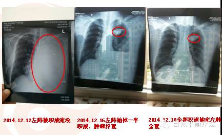 淄博 邢家祥：五个月一个晚期癌症患者的奇迹康复之路