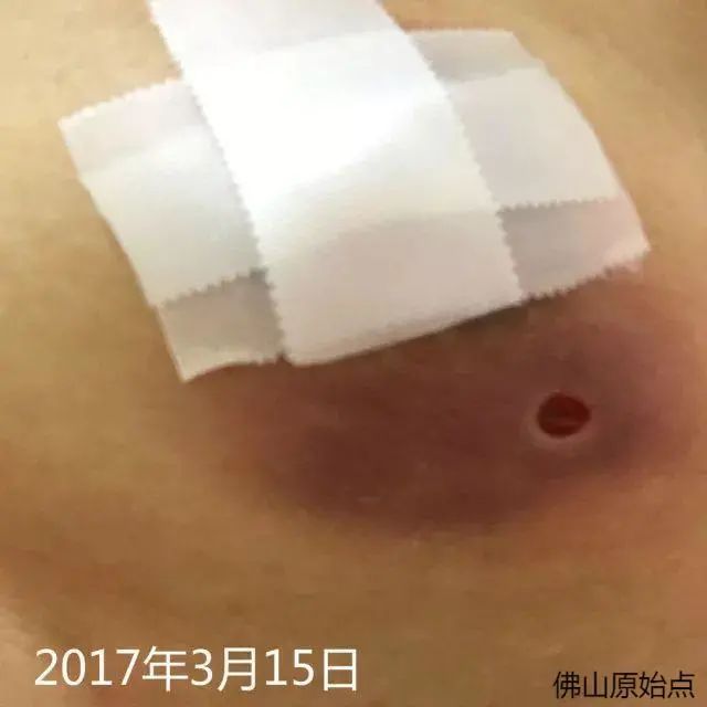 原始点调理乳房溃烂：一位德国媳妇飞越半球的原始点求医经历