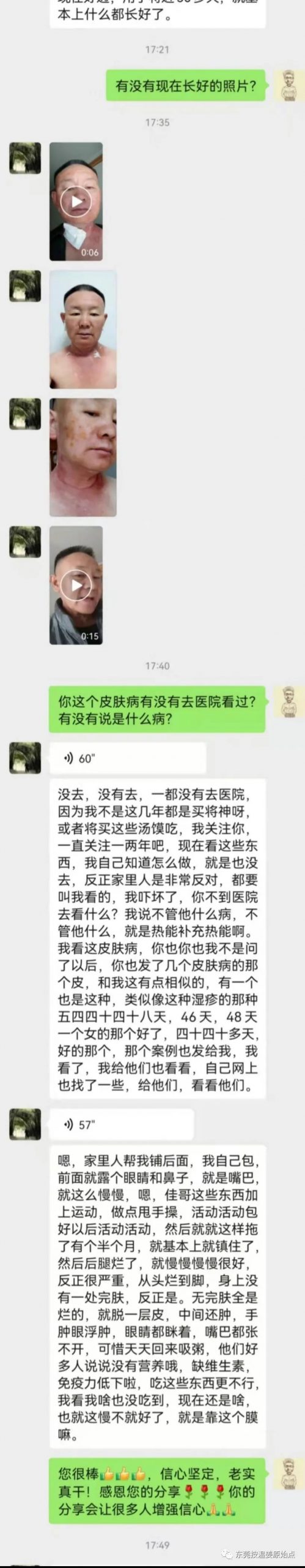 自行在家调理严重湿疹