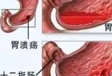 十二指肠球部溃疡＋胃溃疡 案例-原始点全球同学网