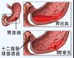 十二指肠球部溃疡＋胃溃疡 案例