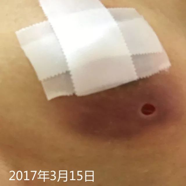 原始点调理乳房溃烂：一位德国媳妇飞越半球的原始点求医经历 - 乳腺增生 乳腺癌 - 佛山市愿天下无痛健康管理服务有限公司