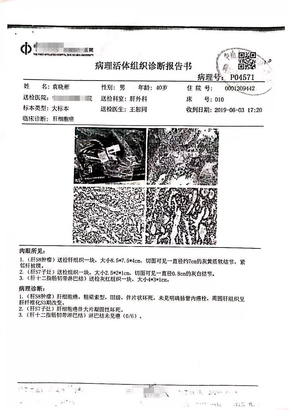 原始点调理肝肿瘤案例——袁晓彬 - 肝硬化 肝腹水 肝癌 - 佛山市愿天下无痛健康管理服务有限公司