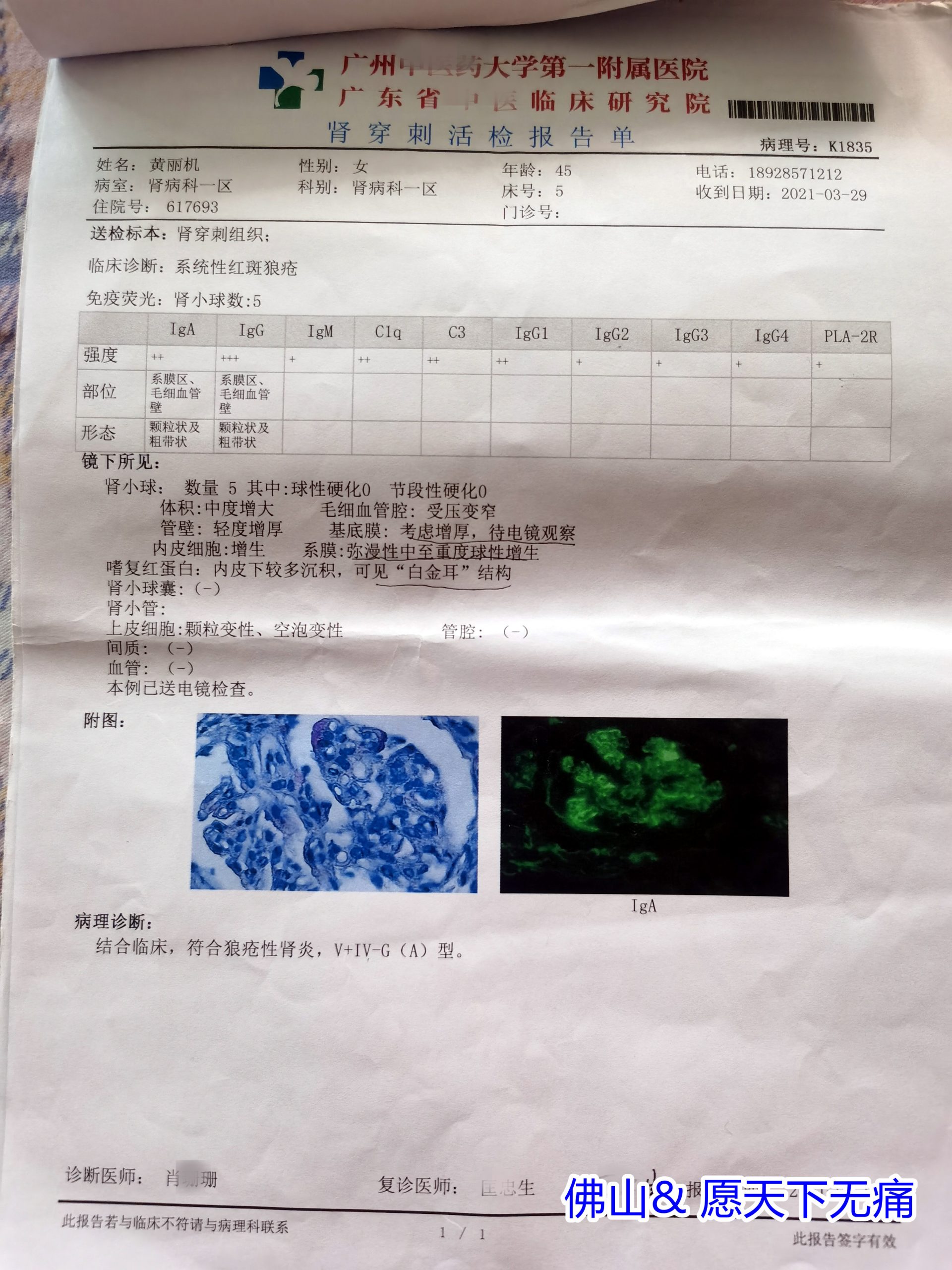 原始点调理红斑性狼疮及治疗后引发并发症康复案例（黄丽机） - 皮肤 - 佛山市愿天下无痛健康管理服务有限公司-原始点全球同学网