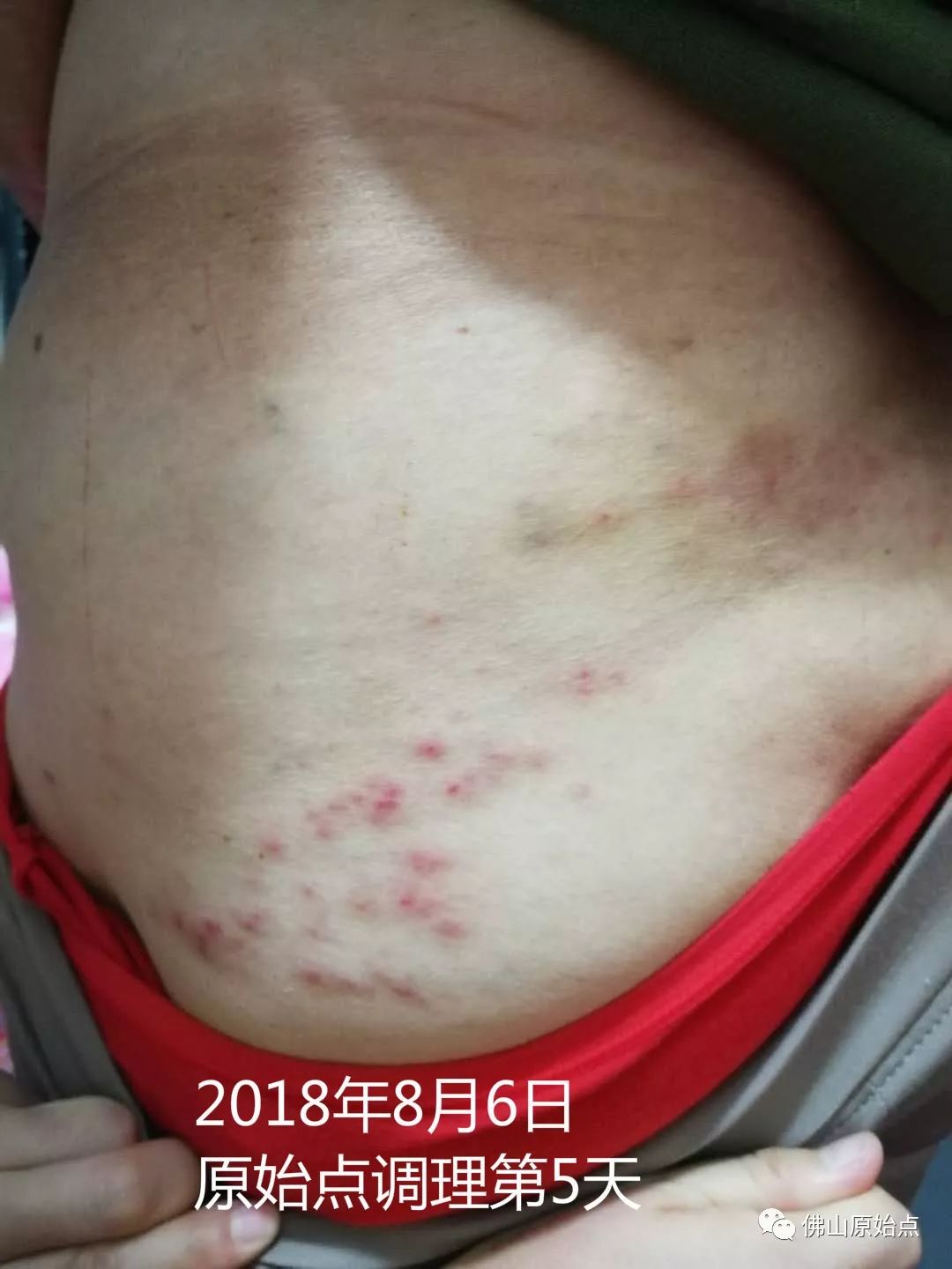 原始点调理带状疱疹：又快又彻底 - 皮肤 - 佛山市愿天下无痛健康管理服务有限公司