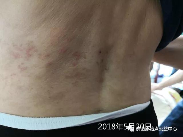 原始点调理带状疱疹：轻松快捷效果好 - 皮肤 - 佛山市愿天下无痛健康管理服务有限公司