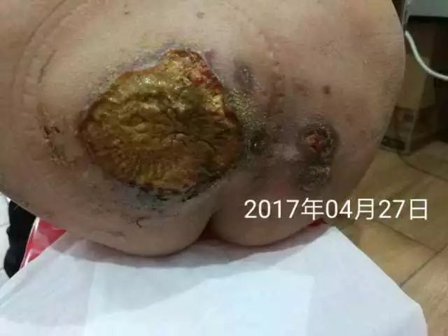 原始点调理淋巴瘤严重溃烂：无任何介入治疗愈合 - 其他癌症与肿瘤 - 佛山市愿天下无痛健康管理服务有限公司