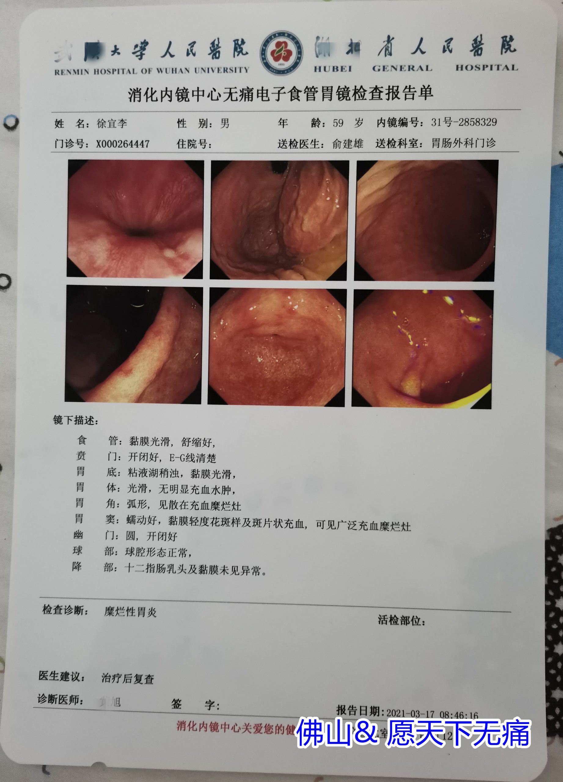 原始点调理冠心病案例（徐宜李） - 身体 五脏六腑 - 佛山愿天下无痛