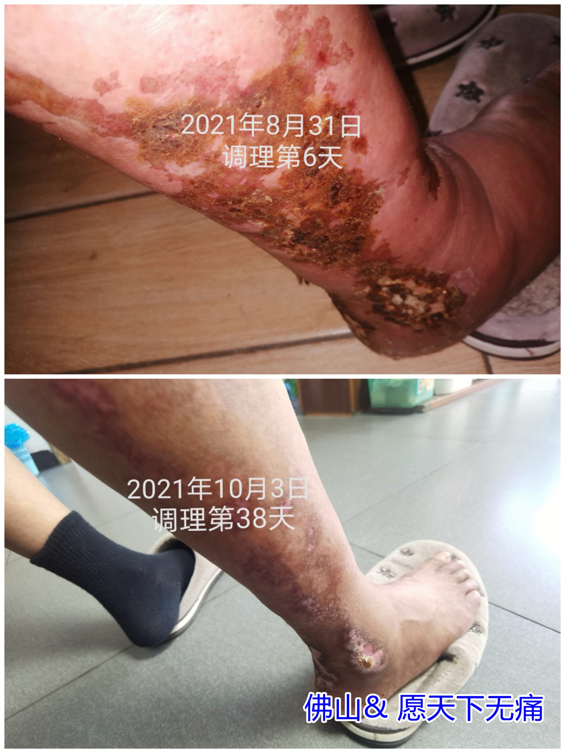 原始点调理骨髓瘤 臀部以下肿痛溃烂、鼻炎 胃炎 关节炎等案例 - 皮肤 - 佛山愿天下无痛