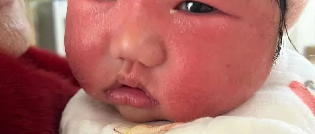 案例分享：3个月婴儿脸上严重湿疹调理案例-原始点全球同学网